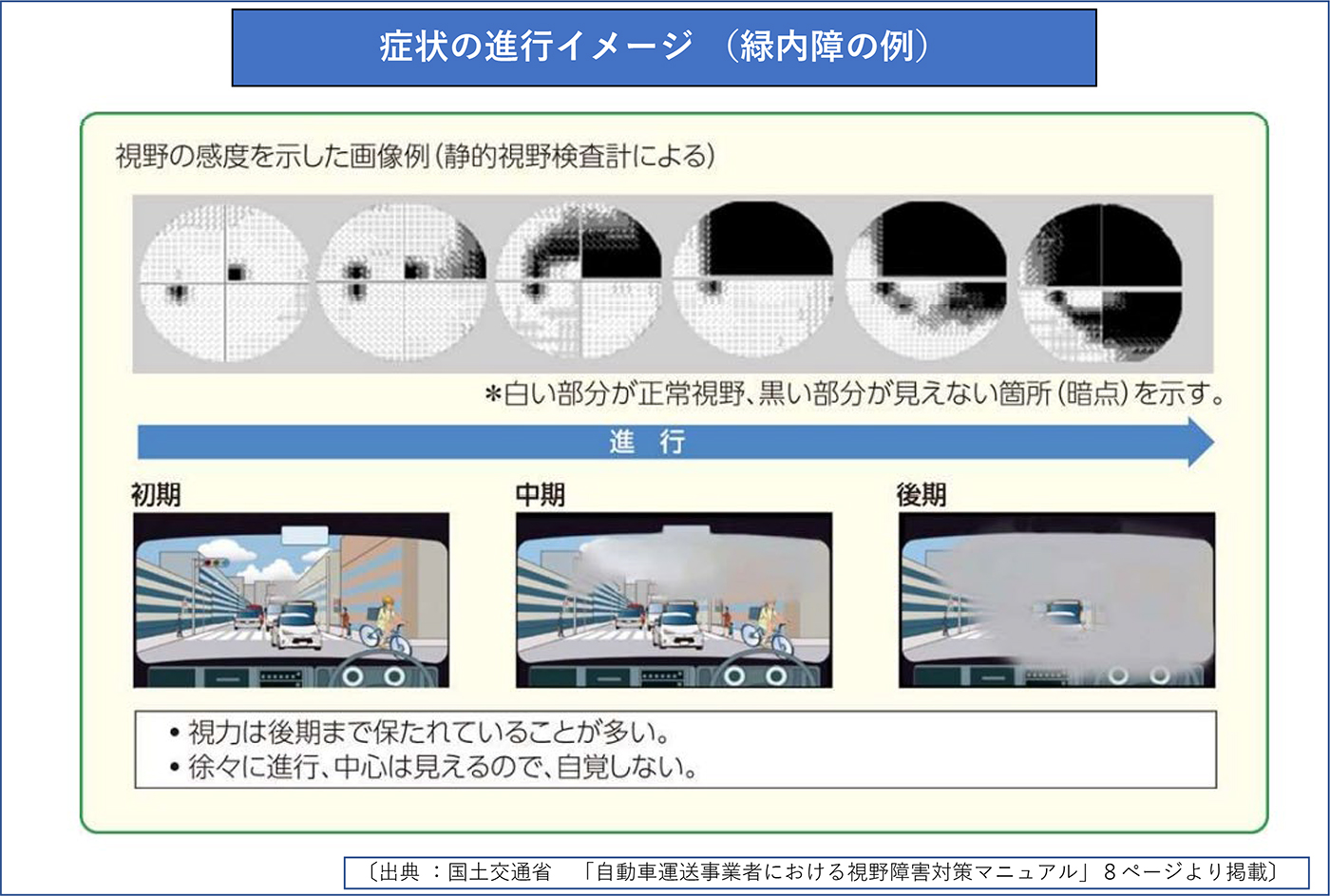 症状の進行イメージ(緑内障の例)